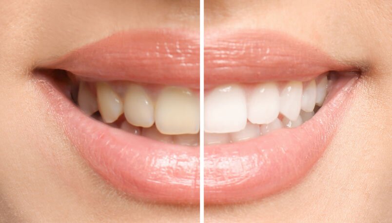 Before & After Teeth Whitening